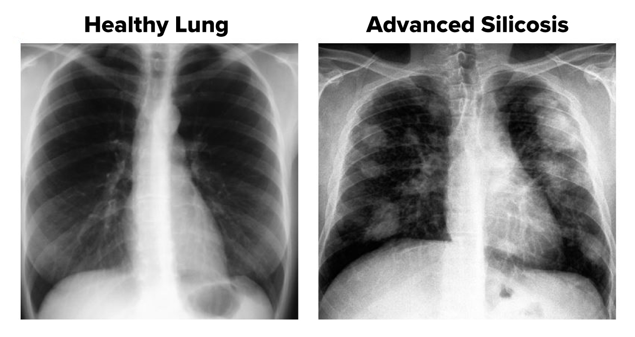silicosis-vs-healthy-lung